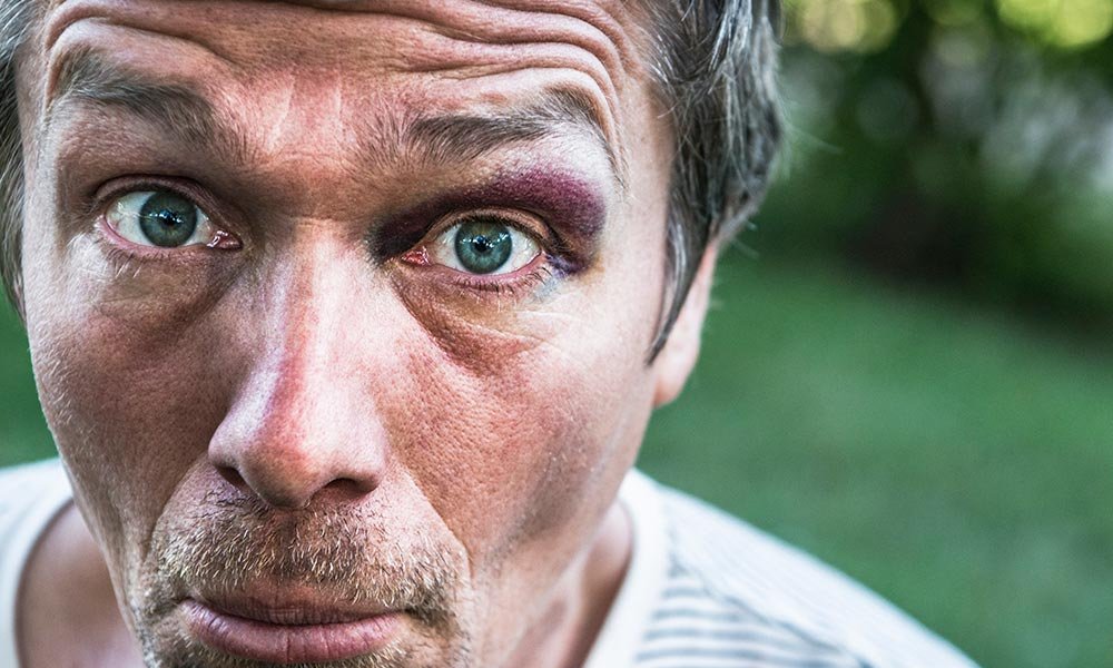 What-are-dilated-pupils